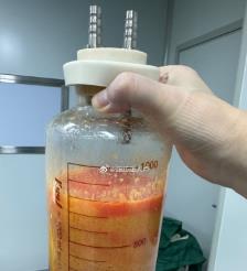肇东水动力吸脂手术要做多久？